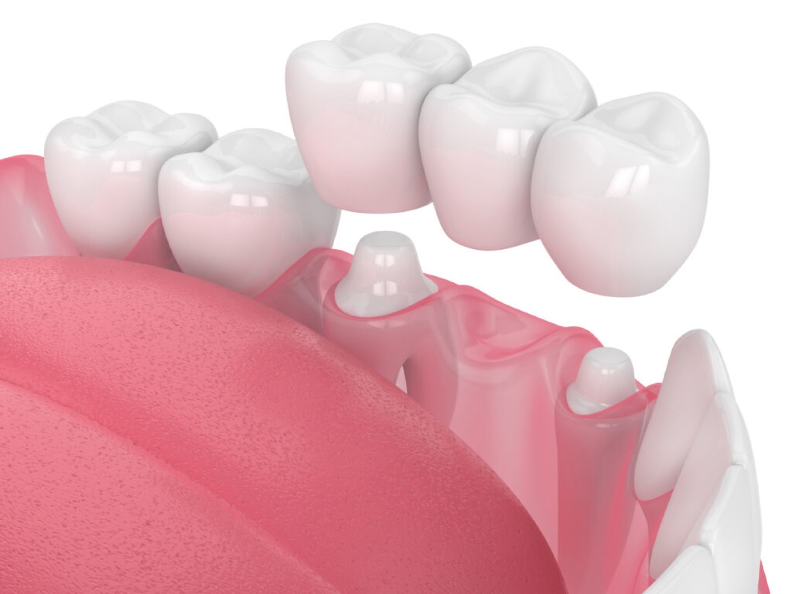 Periodontics at Greater Brainerd Dental